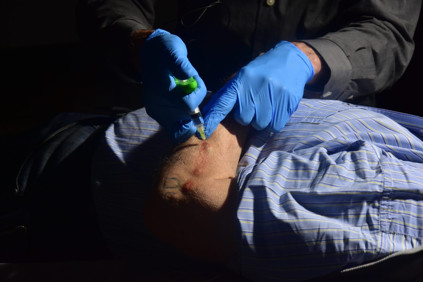Punto de inyección subcutánea en zona cervical durante tratamiento PIT